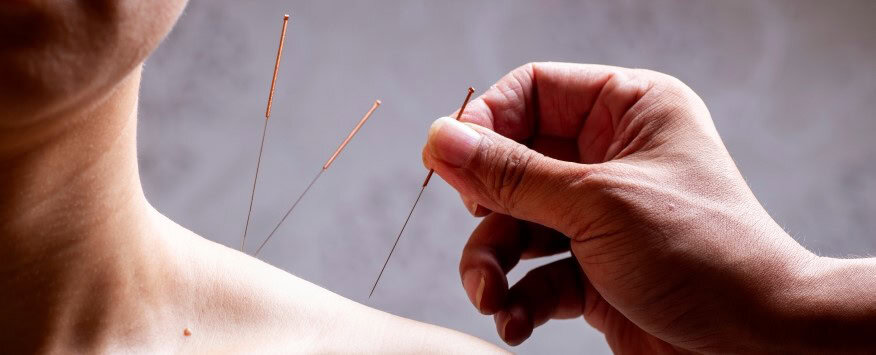 Can Acupuncture Help with Anxiety and Stress?