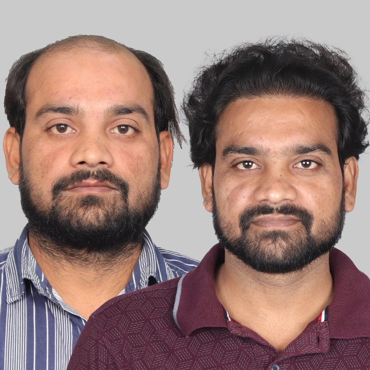 FUE Hair Transplant Cost in India – What You Need to Know