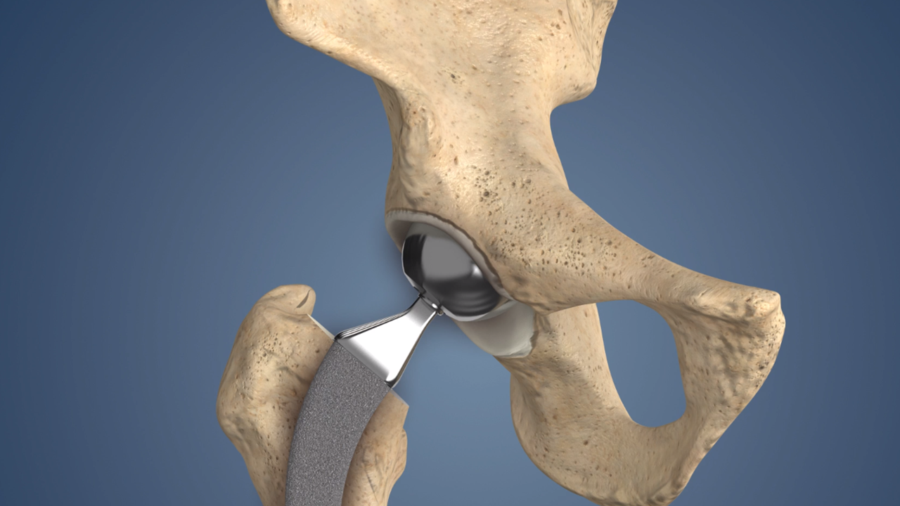 Comparing Hip Surgery Options in Islamabad and Rawalpindi: Which is Better?