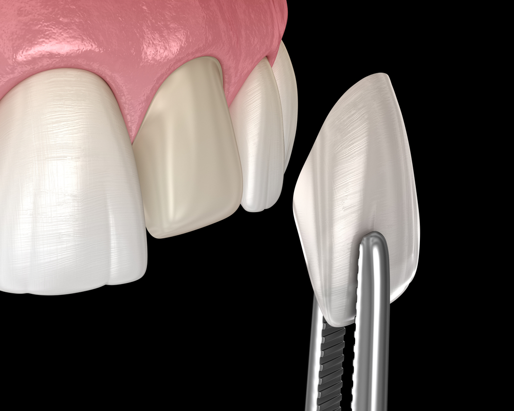 Will Getting Veneers in Dubai Damage My Natural Teeth
