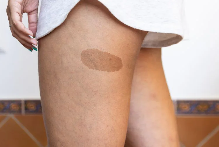 How Effective Is Birthmarks Removal Treatment Now?
