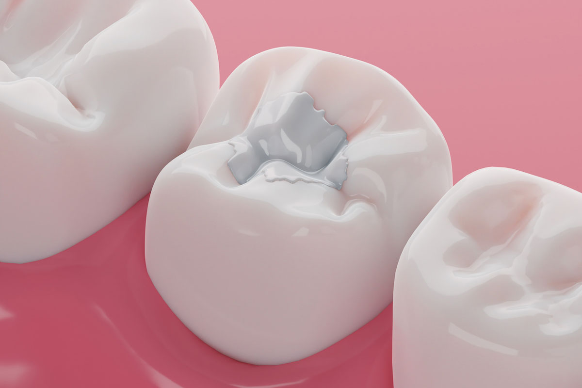 How Long Does Numbness Last After a Filling?