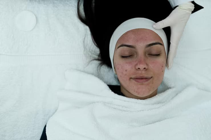 Laser, Peels & More: Effective Acne Treatments in London