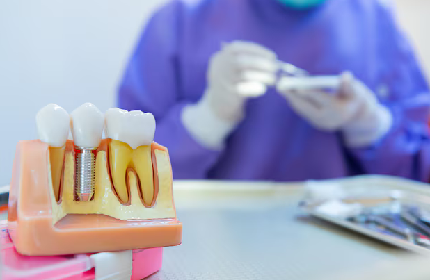 The Science Behind Dental Implants and Osseointegration Dental Implants: The Future of Tooth Replacement