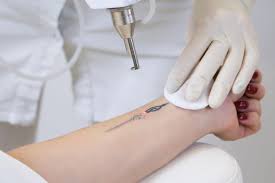 Benefits of Laser Tattoo Removal in Dubai