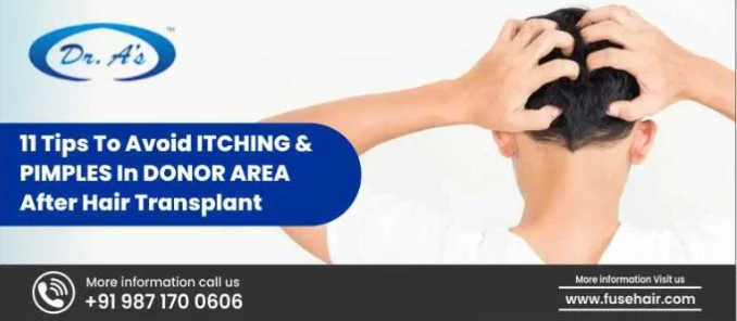 Pimples After Hair Transplant in Donor Area | Best Hair Transplant in India