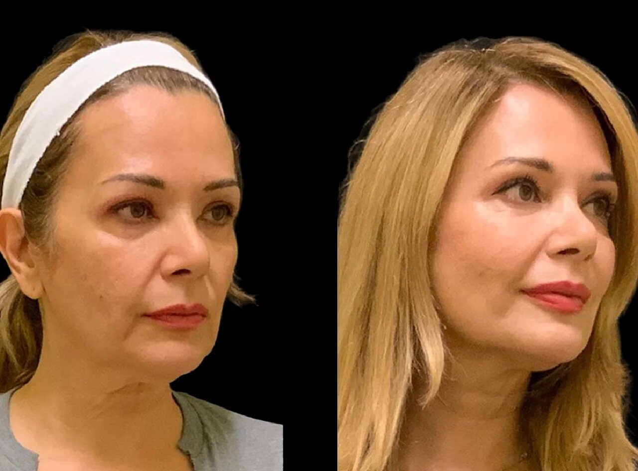 Do Cheek Fillers Treatment in Dubai Provide Natural Results?