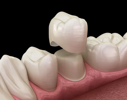 Busting Myths About Crowns in Islamabad