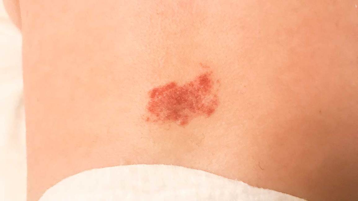 Is Natural Hemangiomas Treatment Effective?