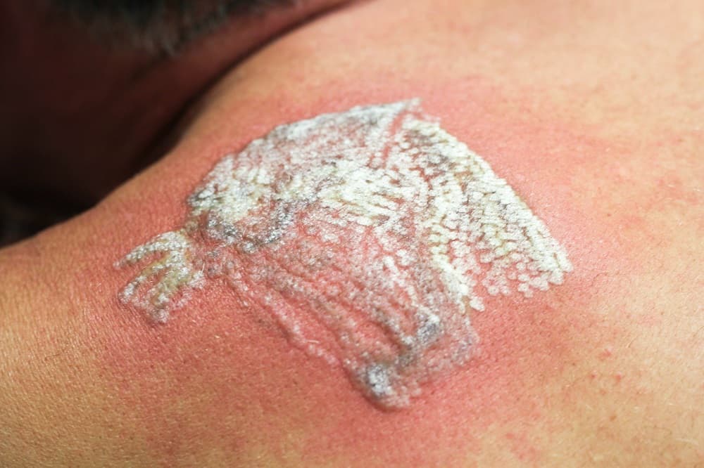 How to Care for Skin After Laser Tattoo Removal?