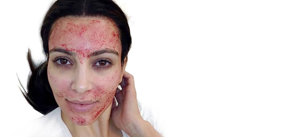 What Are the Benefits of Vampire Facials?