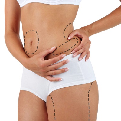 Confidence Redefined: Liposuction Surgery in Riyadh Explained