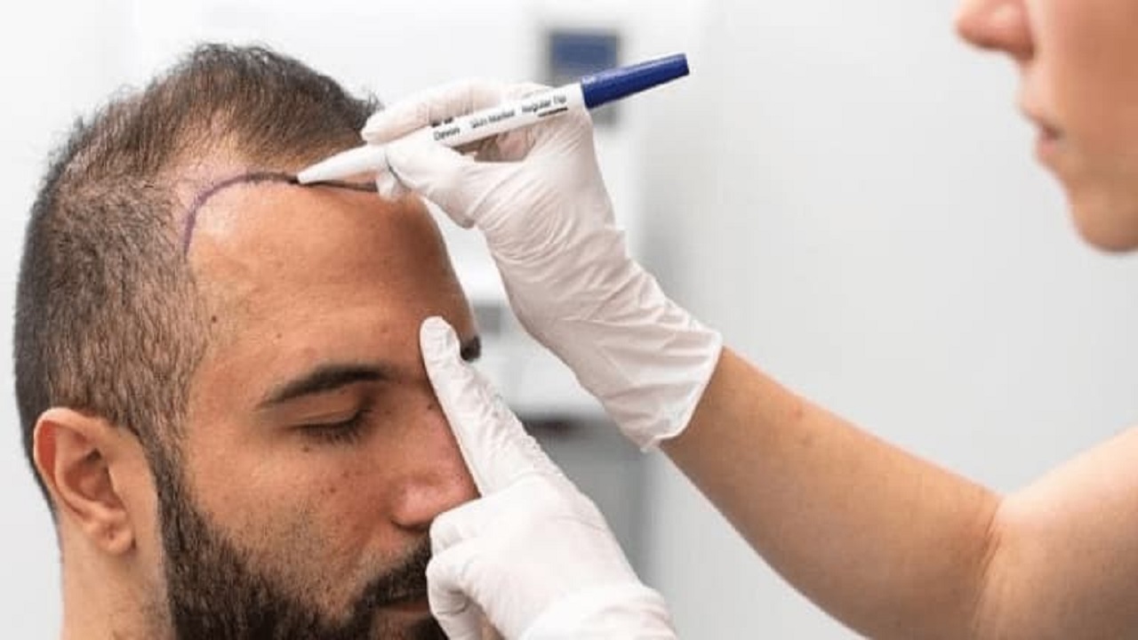 دليل شامل لزراعة الشعر في دبي