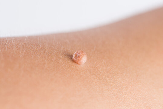 How Can I Tell If It’s A Skin Tag Or Something Else?