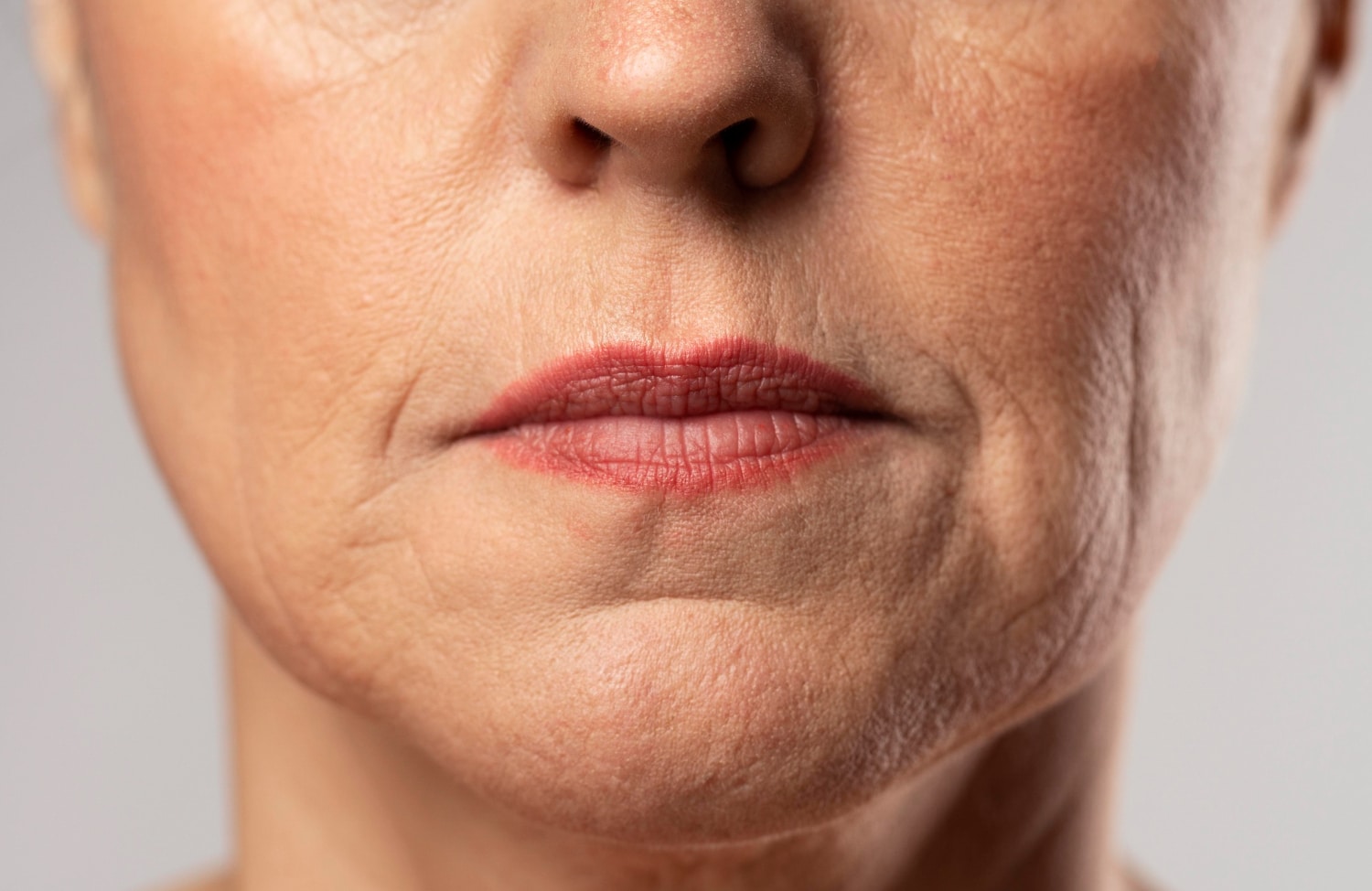 Can Fillers Help with Marionette Lines?