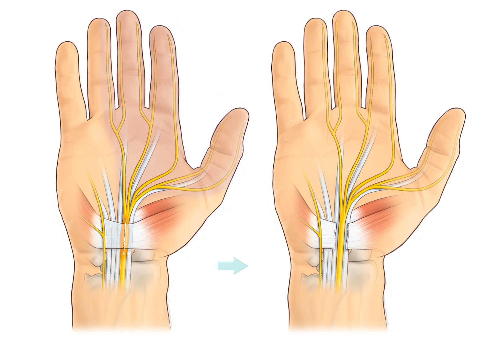 Carpal Tunnel Syndrome in Lahore: When Is It Time to See a Specialist?