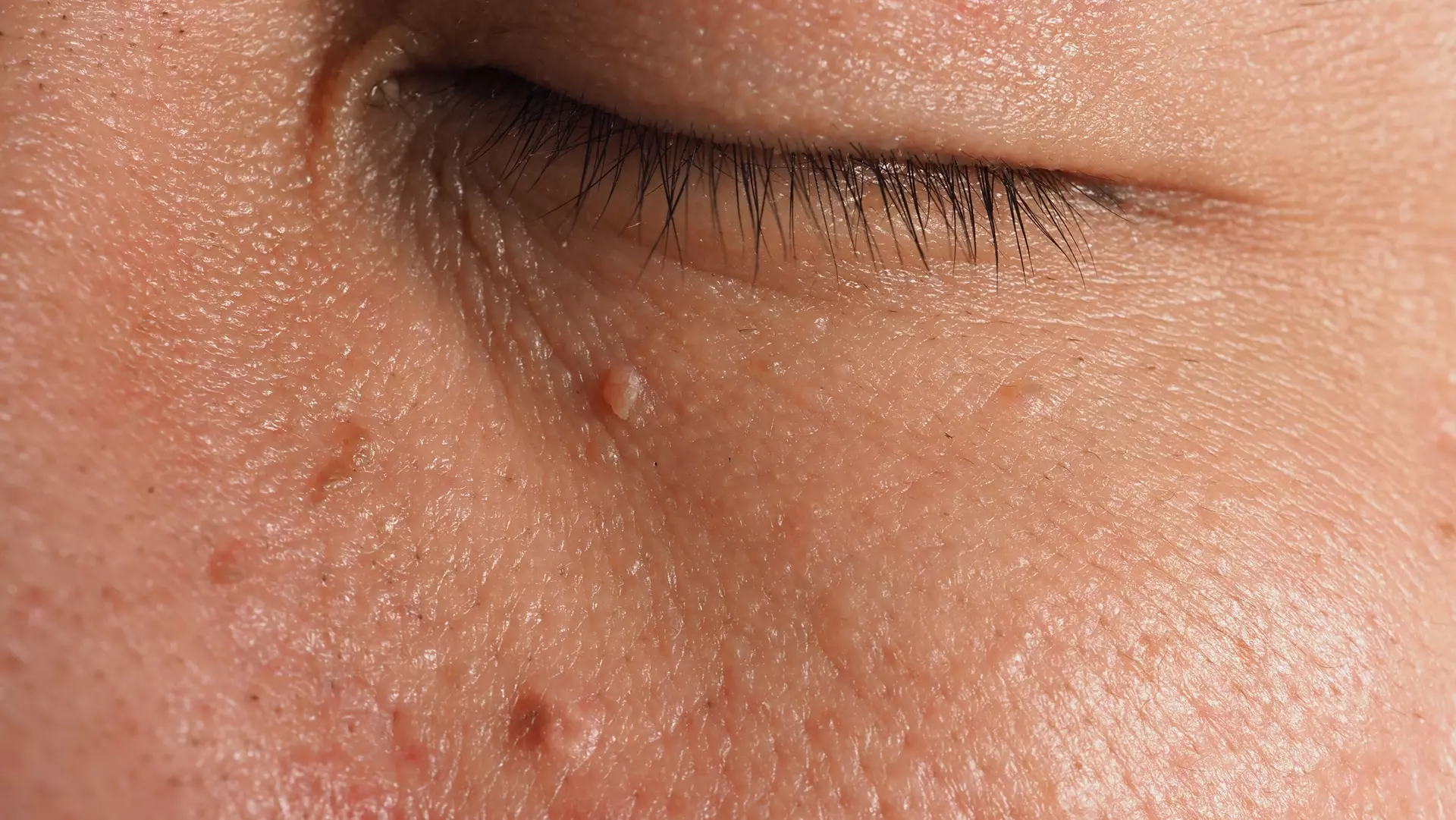 Is Skin Tag Removal Treatment Safe For Sensitive Areas?
