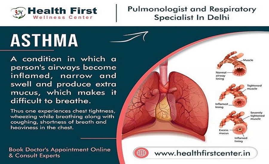 What Makes Dr. Sanchayan Roy a Trusted Asthma Specialist in Delhi?