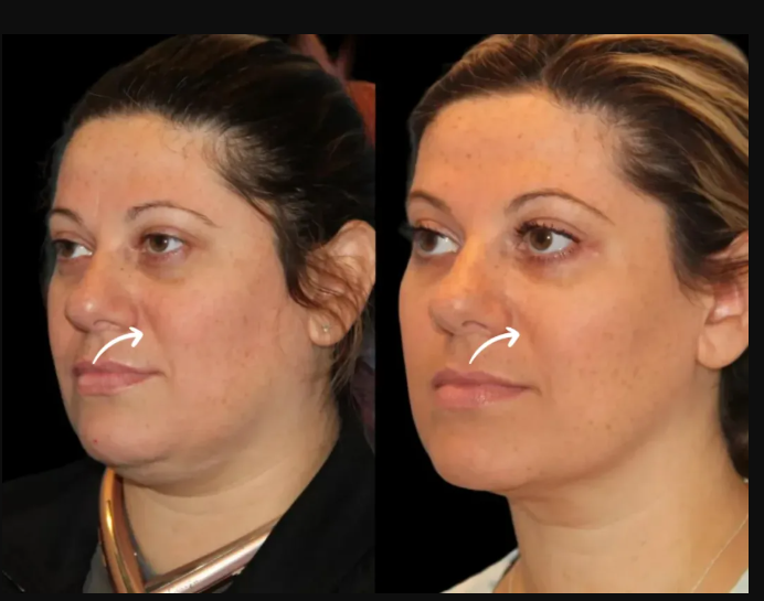 The Best Plastic Surgeon in Dubai for High-Definition Sculptra Fillers