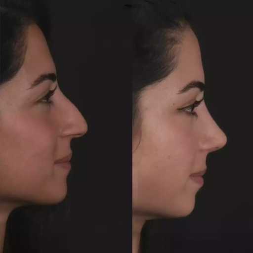 Breathe Better with Help from the Best Doctors in Dubai for Septoplasty