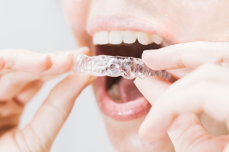 How Invisalign Can Transform Your Smile
