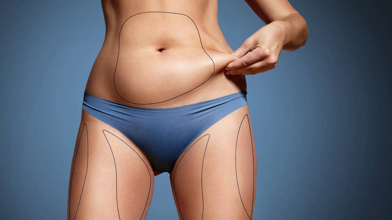 How Long Is the Recovery Time After Liposuction?
