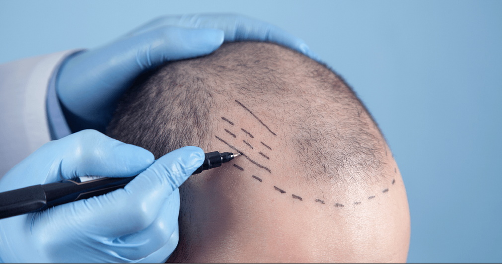 The Future of Hair Transplant Recovery: Fast-Track Healing with Cutting-Edge Technology