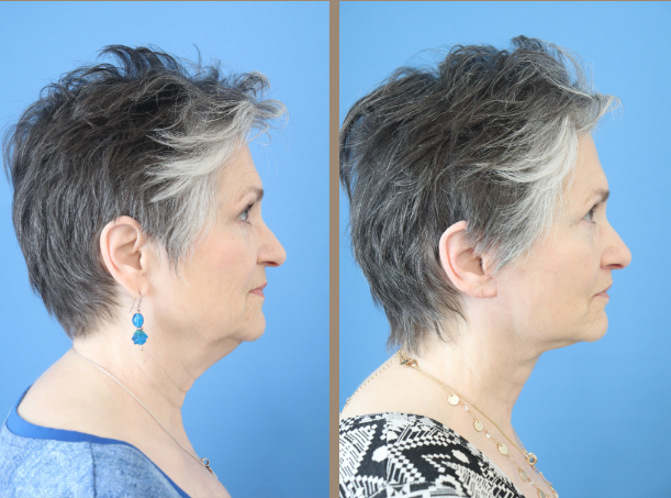 Discover the Best of Austin Facial Plastic Surgery: Your Guide to Looking and Feeling Your Best
