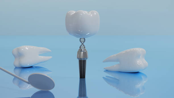 5 Reasons Why Dental Implants Are So Popular
