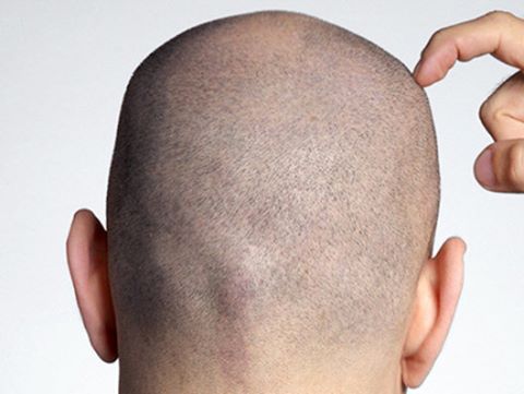 Is hair transplantation in Dubai your ideal option