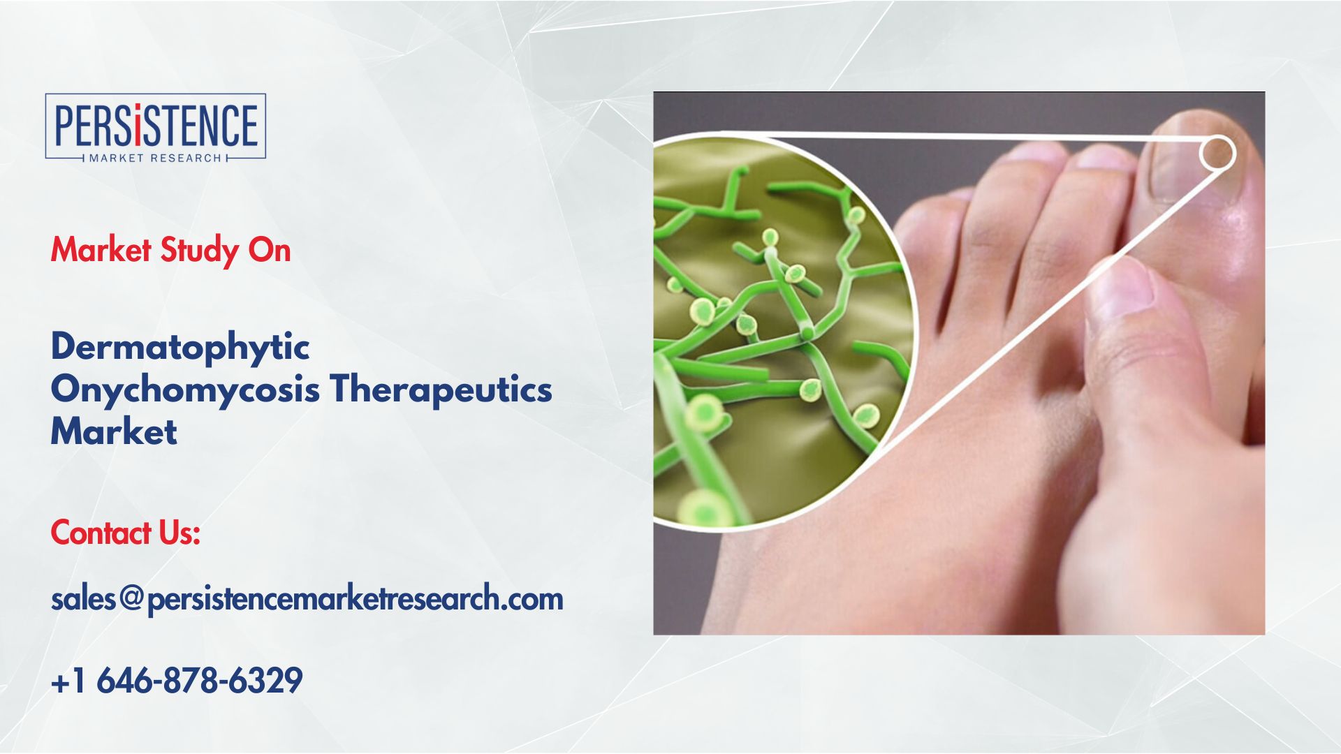 Dermatophytic Onychomycosis Therapeutics Market Demand Rising in Europe