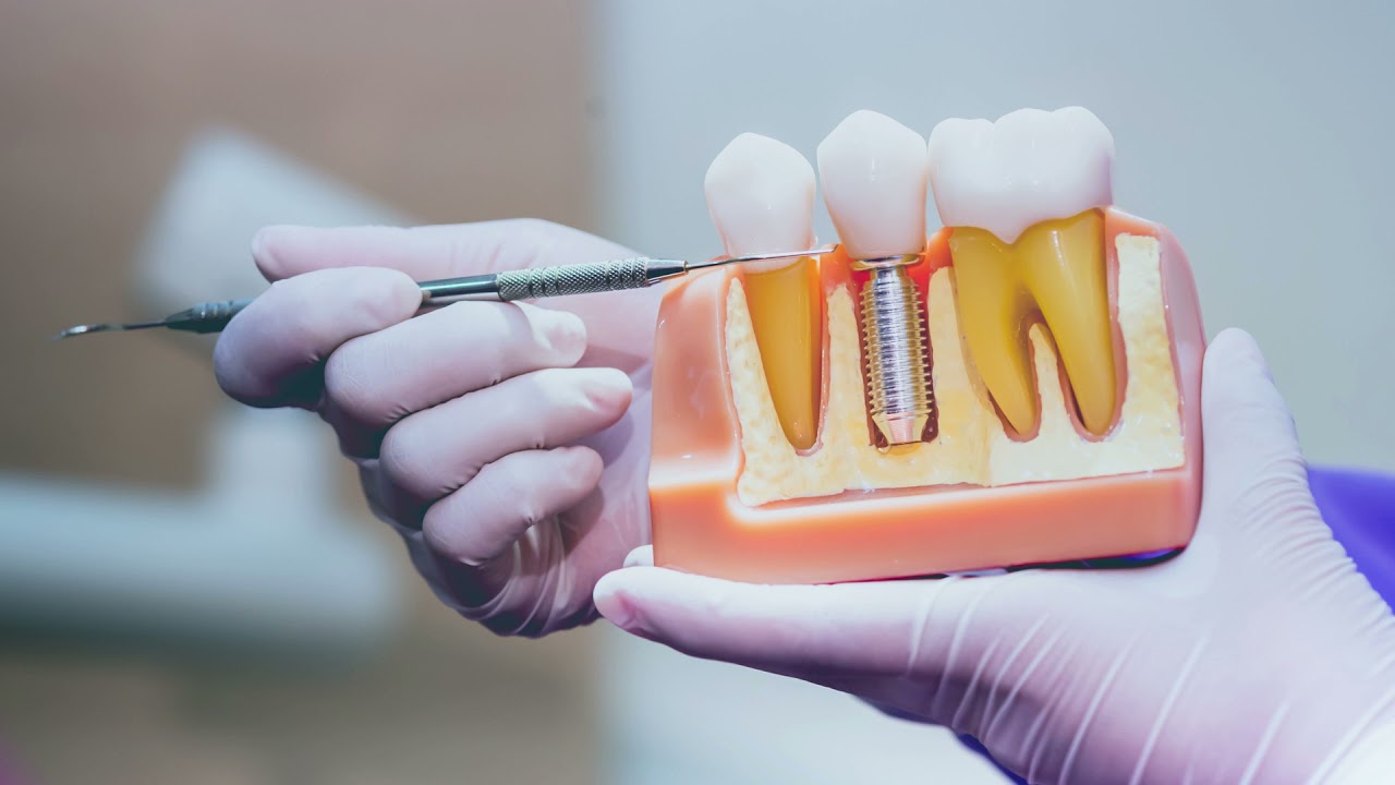 Common Myths About Dental Implants – Busted!