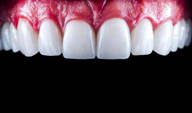 How to Protect Your Natural Teeth Under Veneers from Cavities