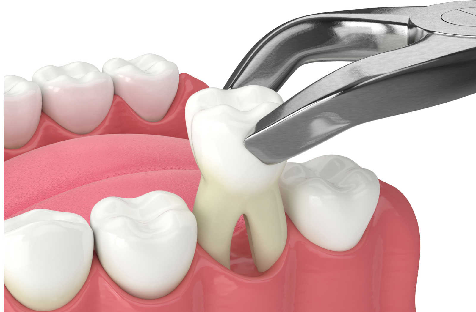 Emergency Tooth Extractions: When to Call a Dentist in Jupiter