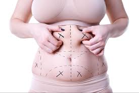 Riyadh’s Top Liposuction Clinics for a Flawless Transformation