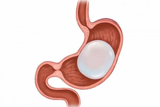 Who Is a Good Candidate for Gastric Balloon Treatment in Dubai
