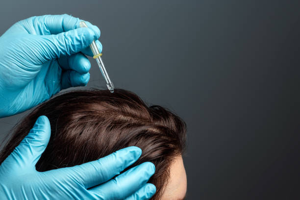 Exosomes Therapy in Riyadh – A Scientifically-Proven Solution for Hair Loss