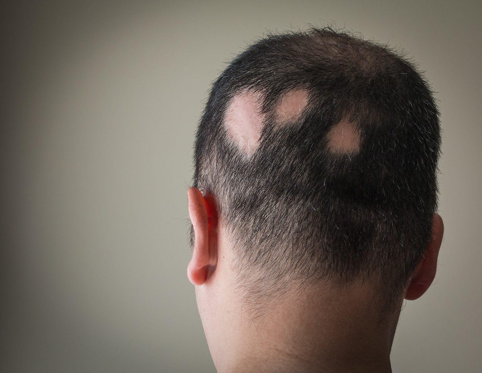 Alopecia Areata in Men: Targeted Treatment Options in Islamabad