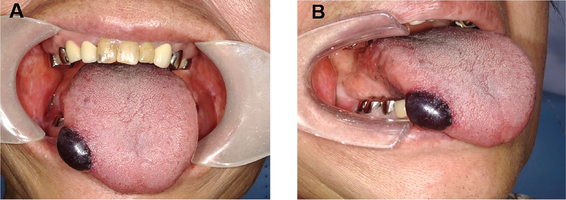 Managing Oral Hematoma