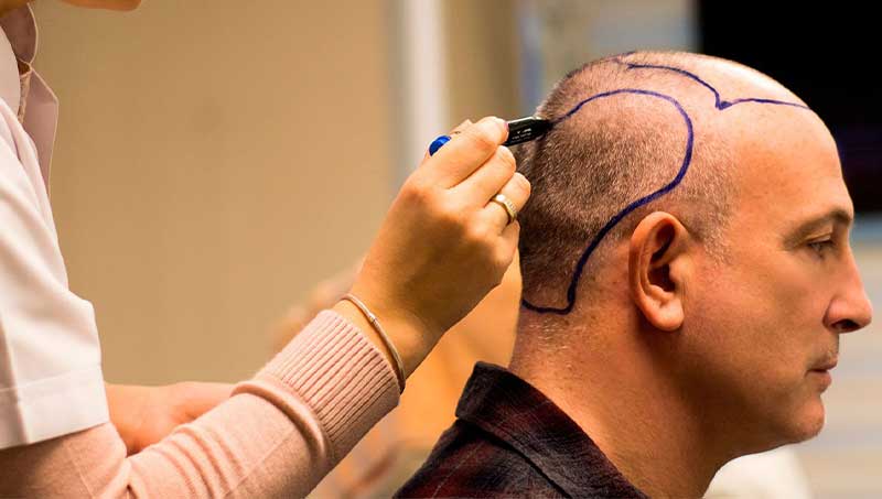 What Is The Best Age For A Hair Transplant?