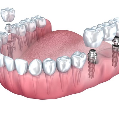 Why Patients Choose Us for Dental Implants