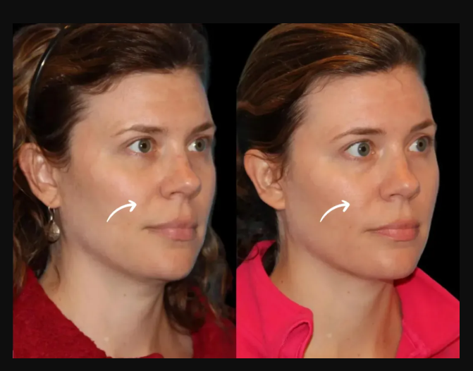 Sculptra Fillers Treatment in Dubai: Before and After Results