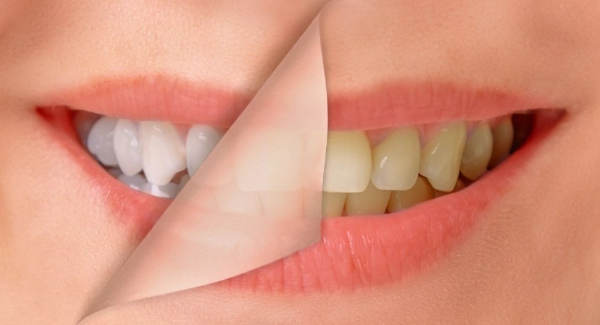 Teeth Cleaning vs. Whitening: What’s the Difference?