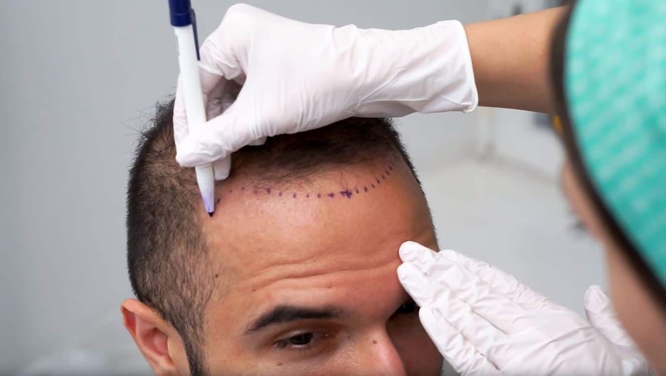 Hair Transplants Treatment That Look Natural