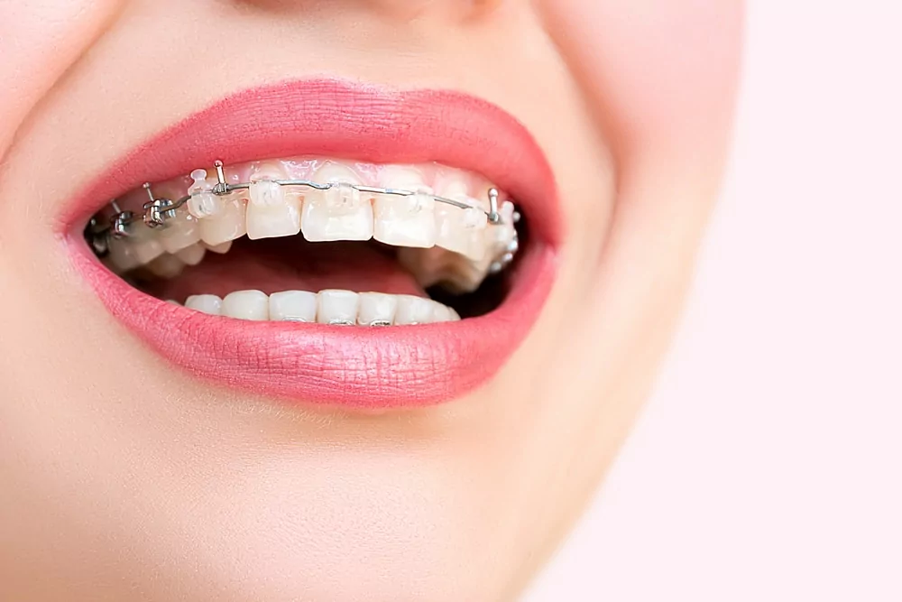 The Truth About Dental Braces Cost and How to Make It Affordable