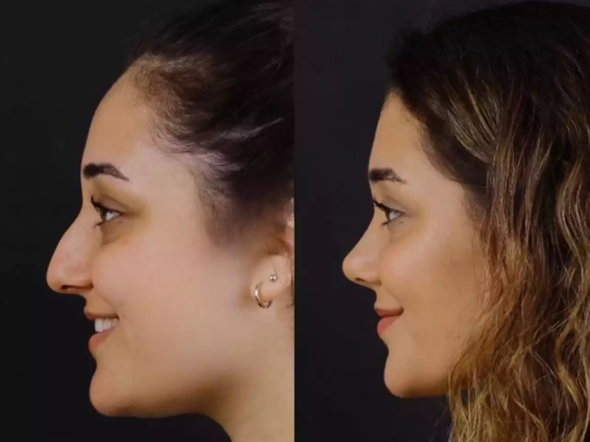 How to Choose a Doctor for Nose Deviated Septum Surgery in Dubai
