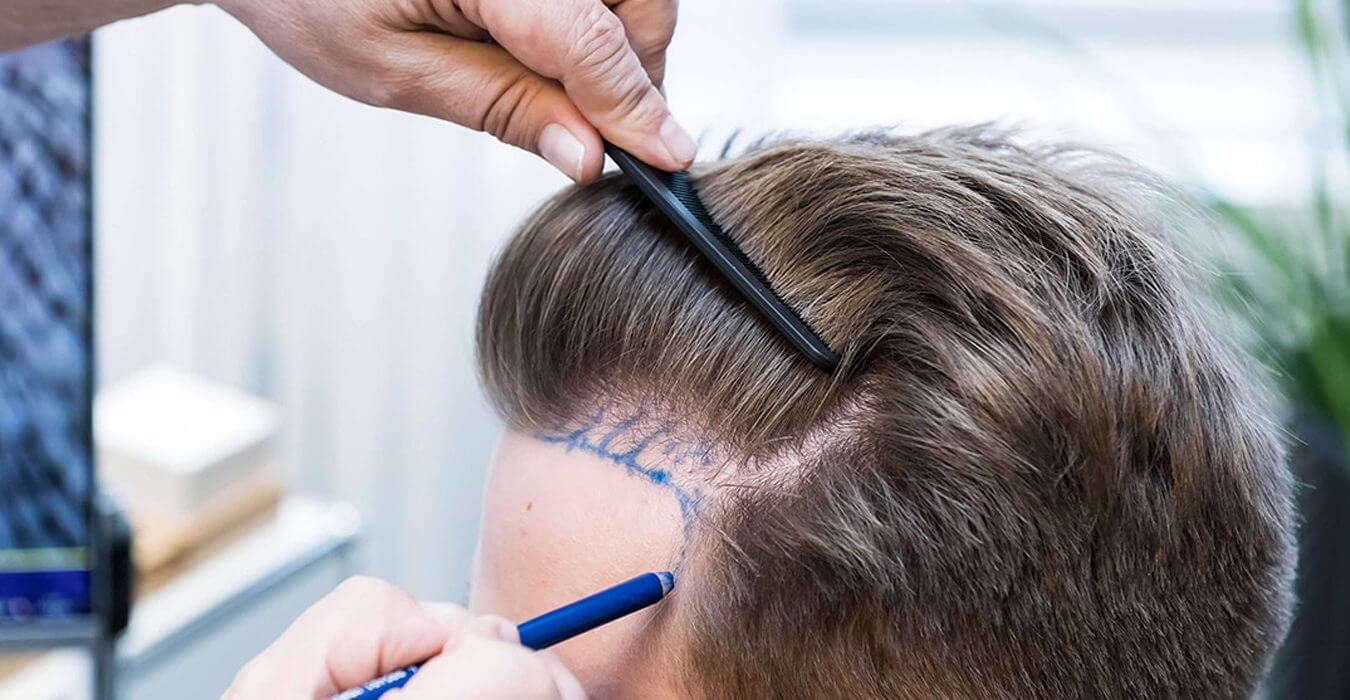 Cost of Hair Transplant in Dubai: A Full Guide