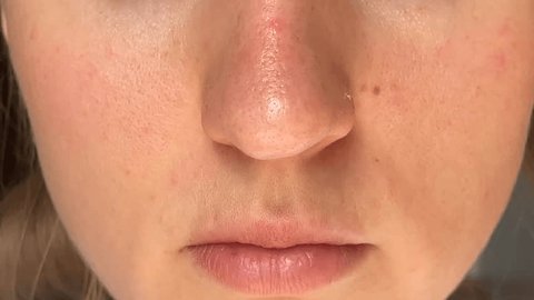 How Does a Dermatologist Remove Skin Tags?