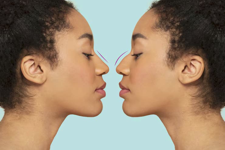 Nonsurgical Rhinoplasty Before and After Photos That Will Amaze You