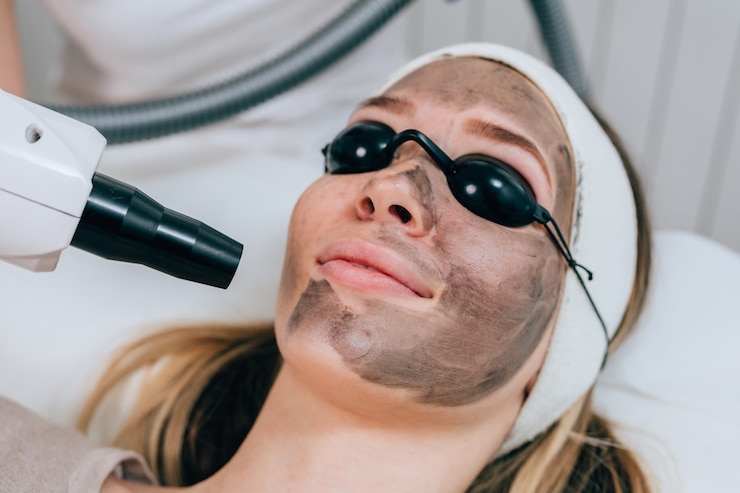 Is Laser Carbon Peel Better Than Microneedling?